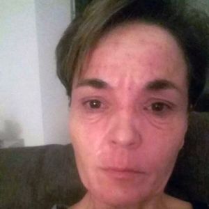 BeautyLight bei starker Neurodermitis