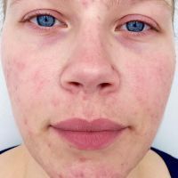 BeautyLight gegen Pickel und Hautrötungen