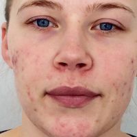 BeautyLight gegen Pickel und Hautrötungen